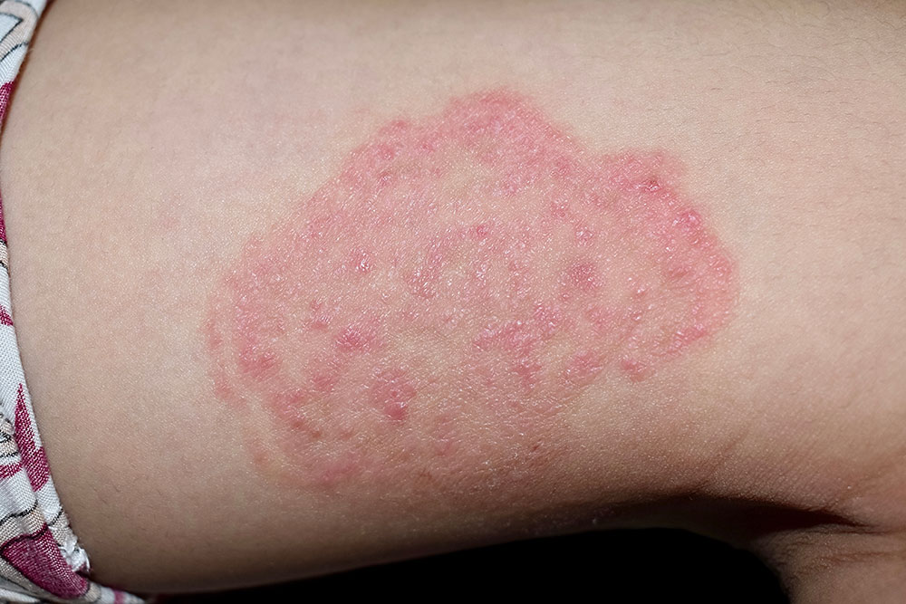 Foto huidklachten bij diabetes